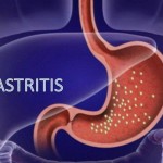 Bacteria causante de la gastritis