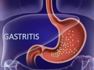 gASTRITIS