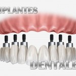 Alternativas de implantes dentales