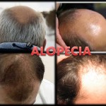 La Alopecia