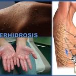 Tratamiento de la Hiperhidrosis o sudoración excesiva