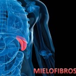 Mielofibrosis