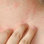 Psoriasis