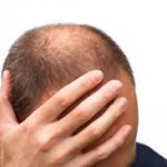 Alopecia