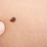 Melanoma