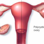 Síndrome de ovarios poliquísticos