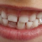 Fluorosis dental en niños