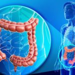 Cáncer de colon: prevención y tratamiento