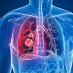 Hipertensión pulmonar: qué es y cómo detectarla