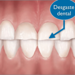 Desgaste Dental