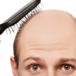 Alopecia: causas y tratamiento