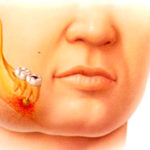 ¿Qué es la celulitis facial?
