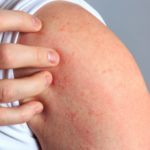 Dermatitis por contacto alérgico